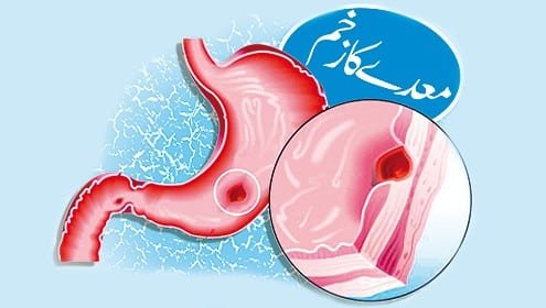 معدے کا السر دیسی اور ہومیوپیتھک علاج
