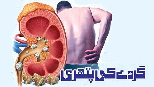 امراض گردہ، پتھری