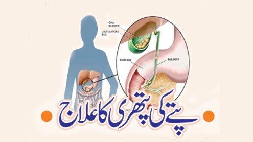 پتے میں درد ،پتے میں پتھریاں تکالیف ،علامات اور ہومیوپیتھی ادویات سے علاج