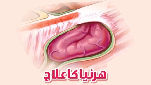 ہرنیا