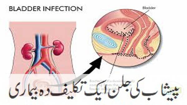 پیشاب کی جلن اور تکالیف