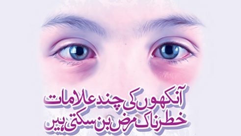 IRRITATION  REDNESS IN EYES