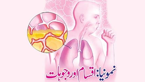 نمونیا/ذات الجنب, PNEUMONIA