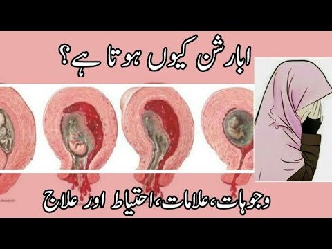 اسقاط حمل تکالیف،علامات  ہومیو پیتھی 1طریقہ علاج