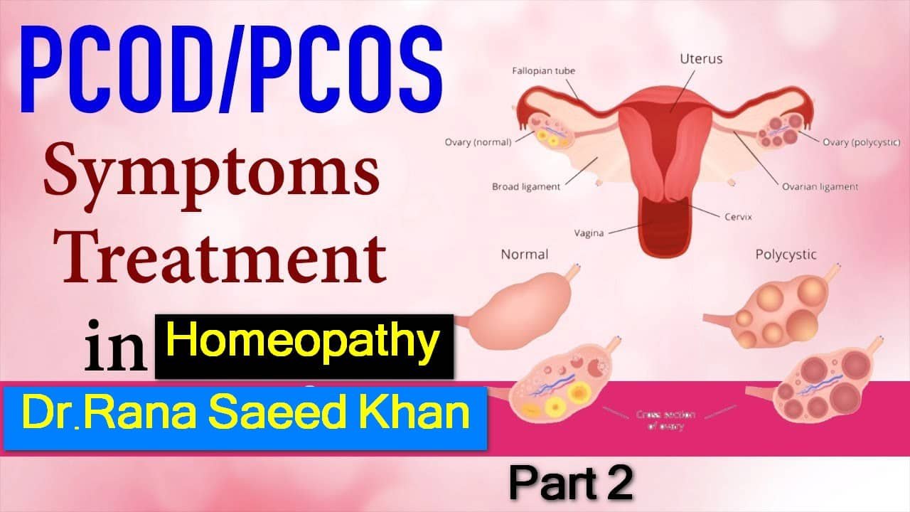 PCOS رحم کی تھیلیاں، چہرے پر بال اور متفرق