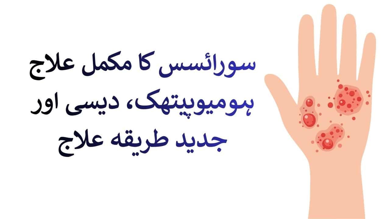 سورائسس کا مکمل علاج | ہومیوپیتھک، دیسی اور جدید طریقہ علاج